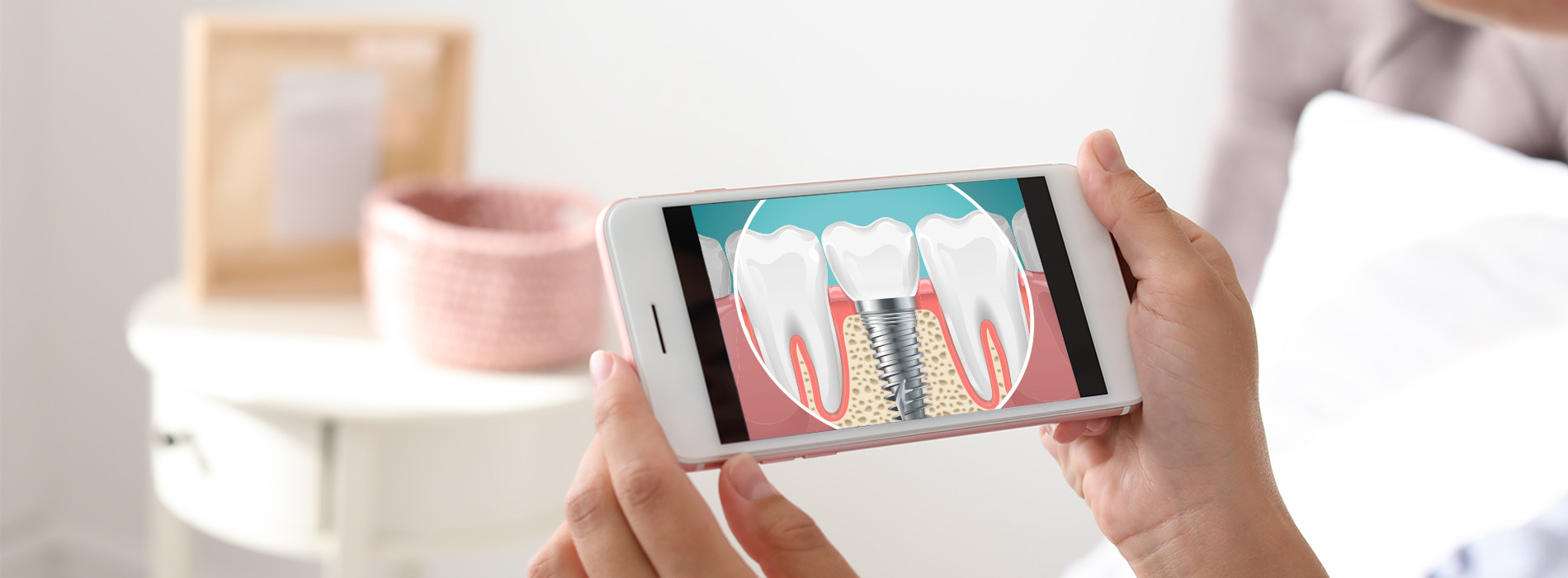Dental Implants Dentist in Cartersville