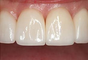 Allatoona Family Dental | Crown Lengthening, Snap-On Smile and Digital Radiography